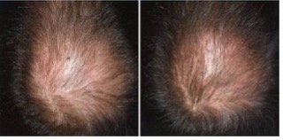 صورة قبل إعادة نمو الشعر وبعدها أثناء التجارب السريرية بعد استخدام ريجين®