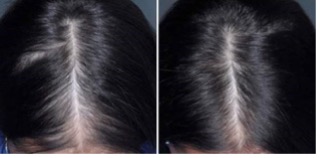 Before and after image of hair regrowth during clinical trials after using REGAINE®