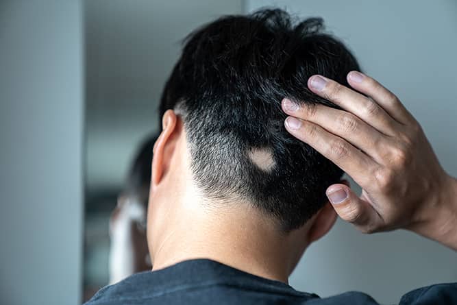 a man experiencing alopecia areata hair loss