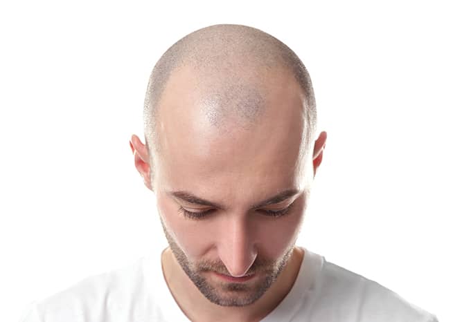 a man with male pattern baldness