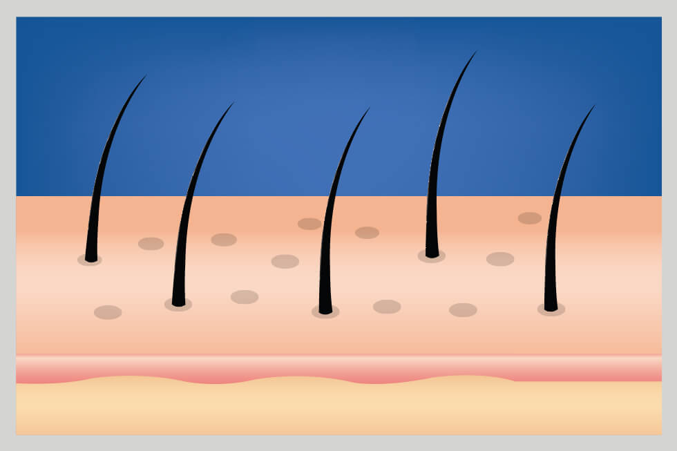 Scalp with few hairs, showing the causes hair loss.