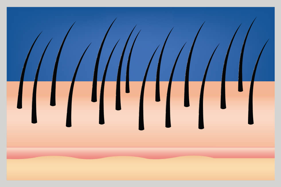 Scalp with multiple hairs, a full head of hair before hair loss occurs to display causes of hair loss.
